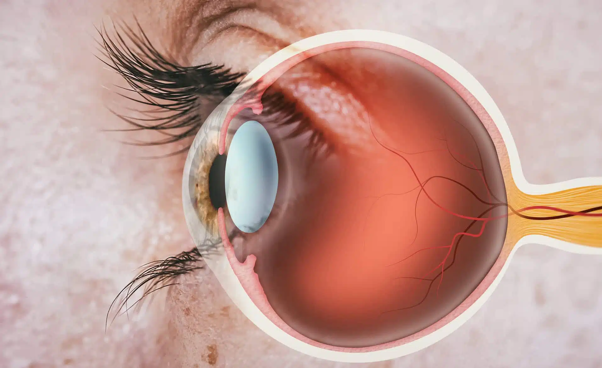 Cornea Transplant in Turkey