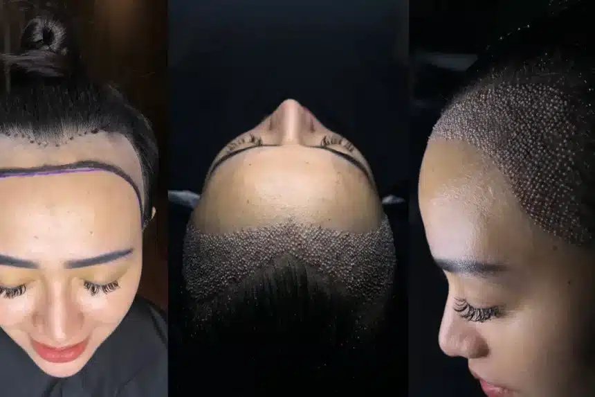 Hair Transplant for Women in Turkey