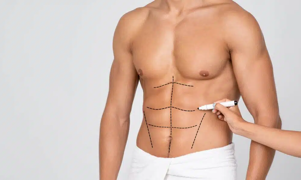 Abdominal Etching in turkey