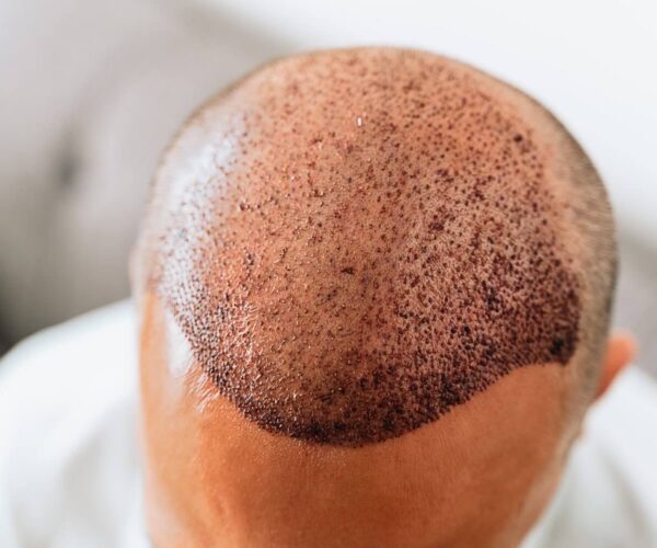 best countries for hair transplant