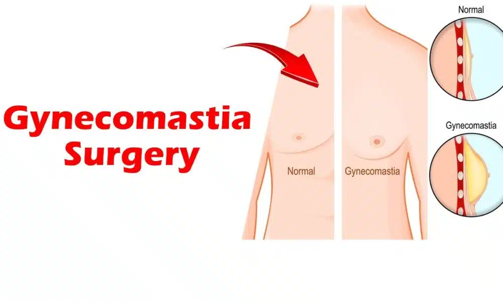 gynecomastia surgery in Turkey