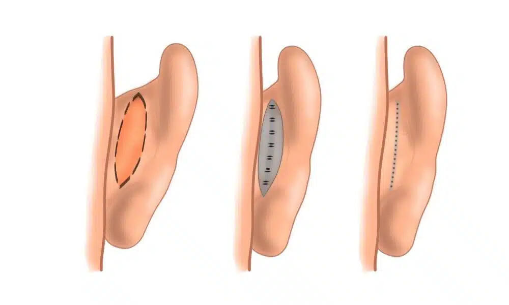 Otoplasty in Turkey
