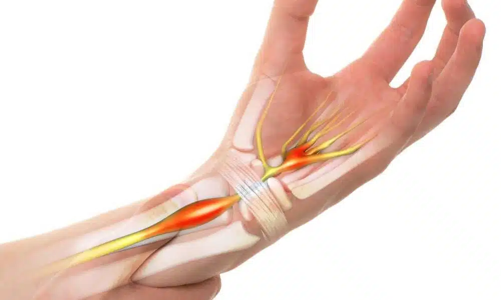 carpal tunnel surgery in turkey