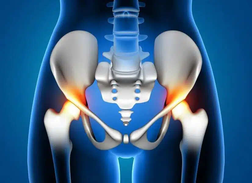 hip replacement in turkey