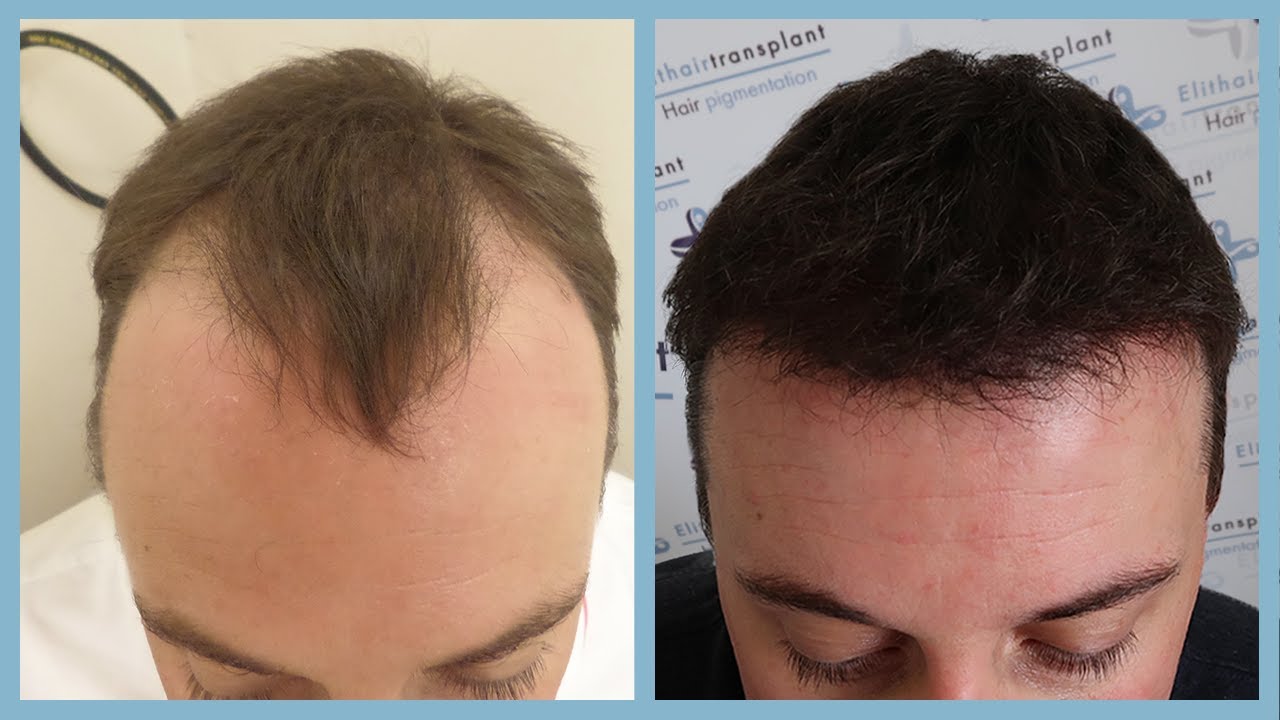 best hair transplant in Turkey price