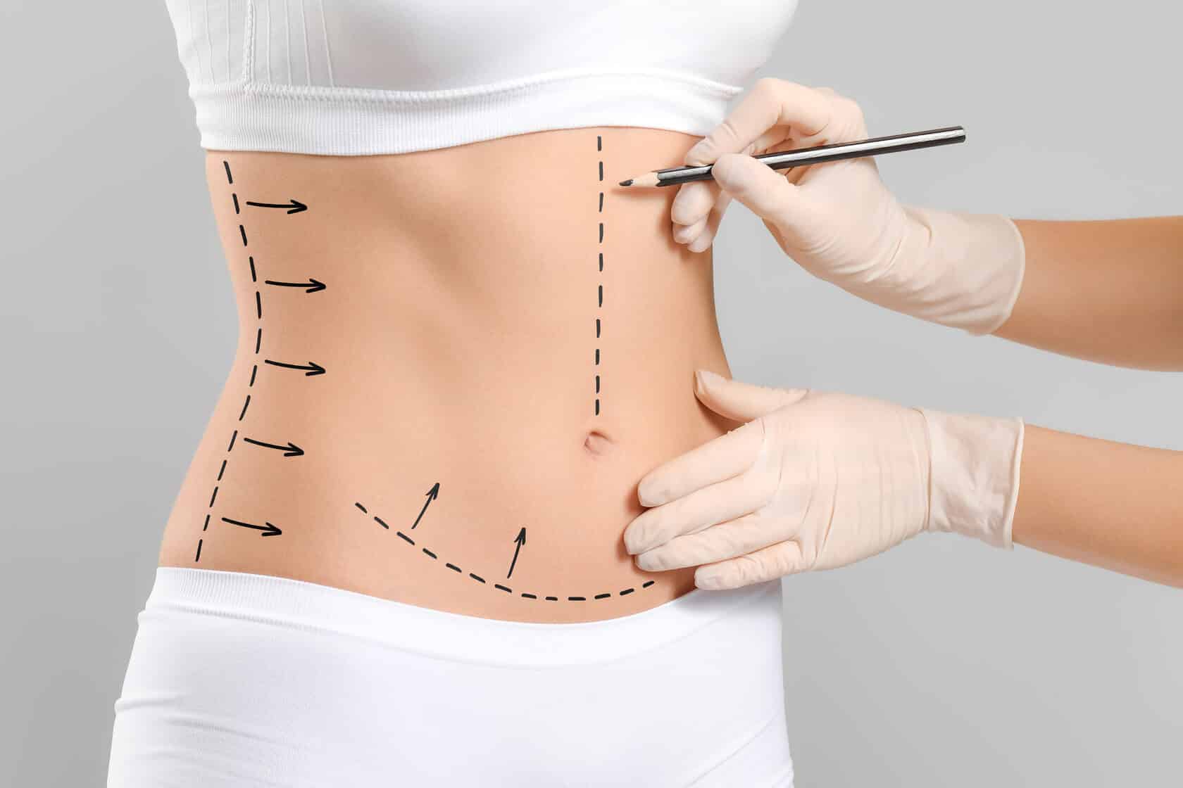 Body Lift Surgery