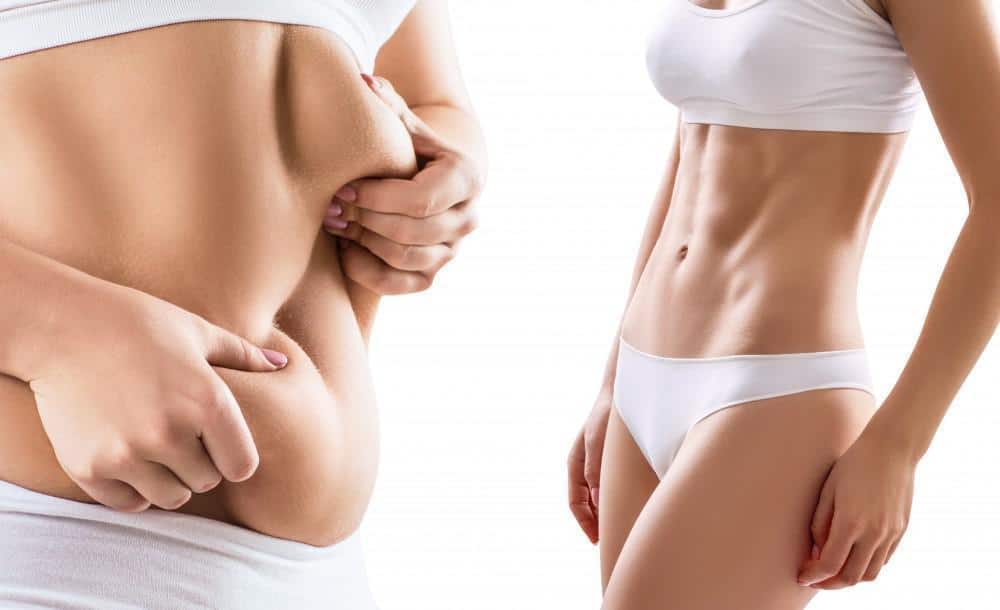Body Lift Surgery