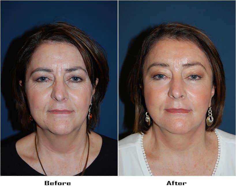 Endoscopic eyebrow lift
