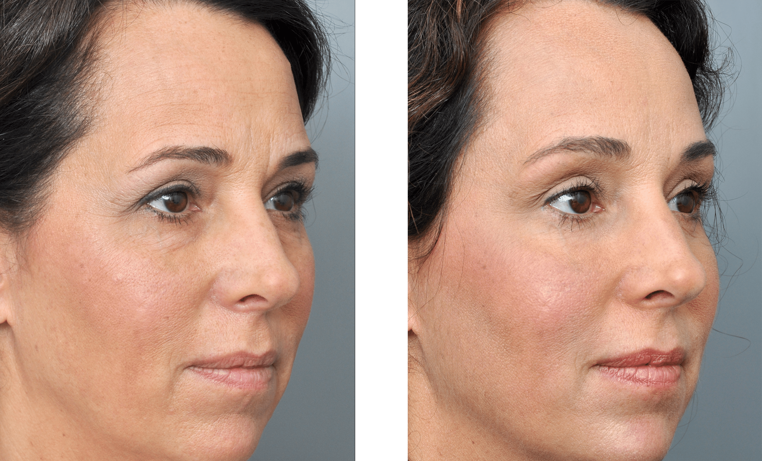 Forehead Surgery