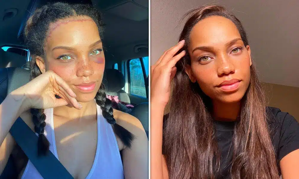 Forehead Surgery