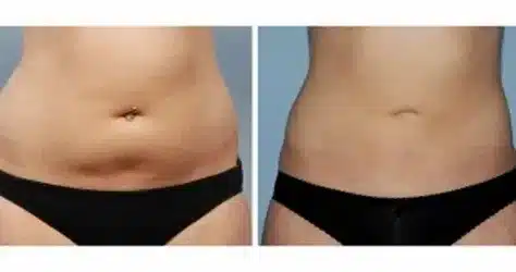 Lipo Gone Wrong