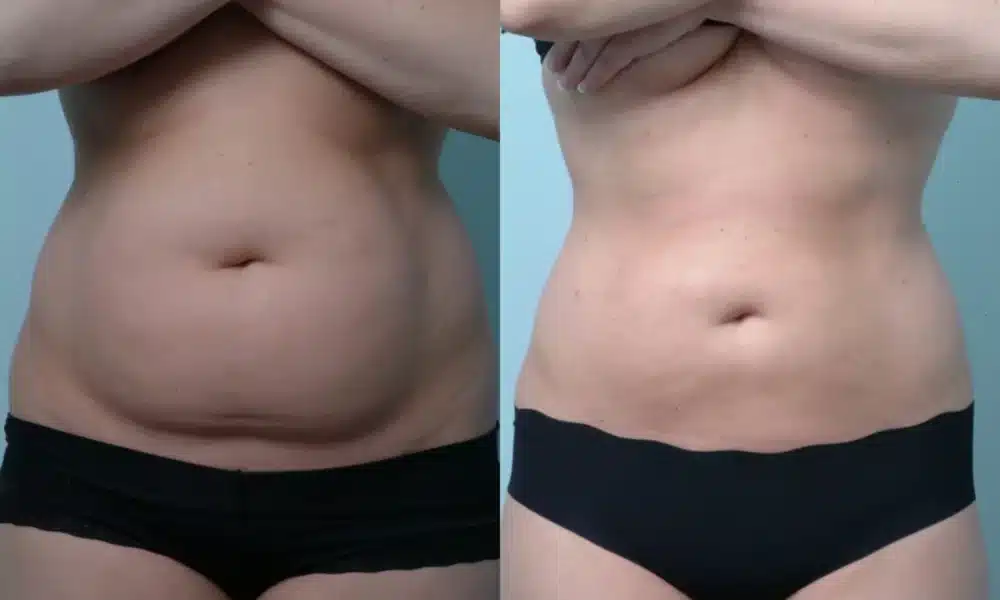 Lipo Gone Wrong