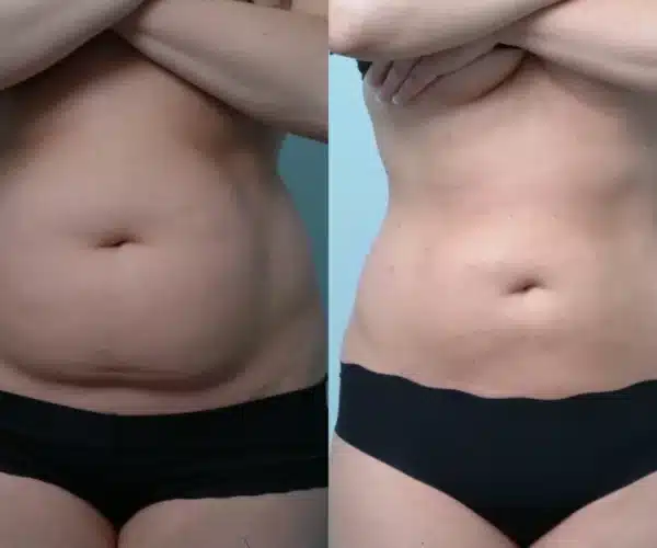 Lipo Gone Wrong