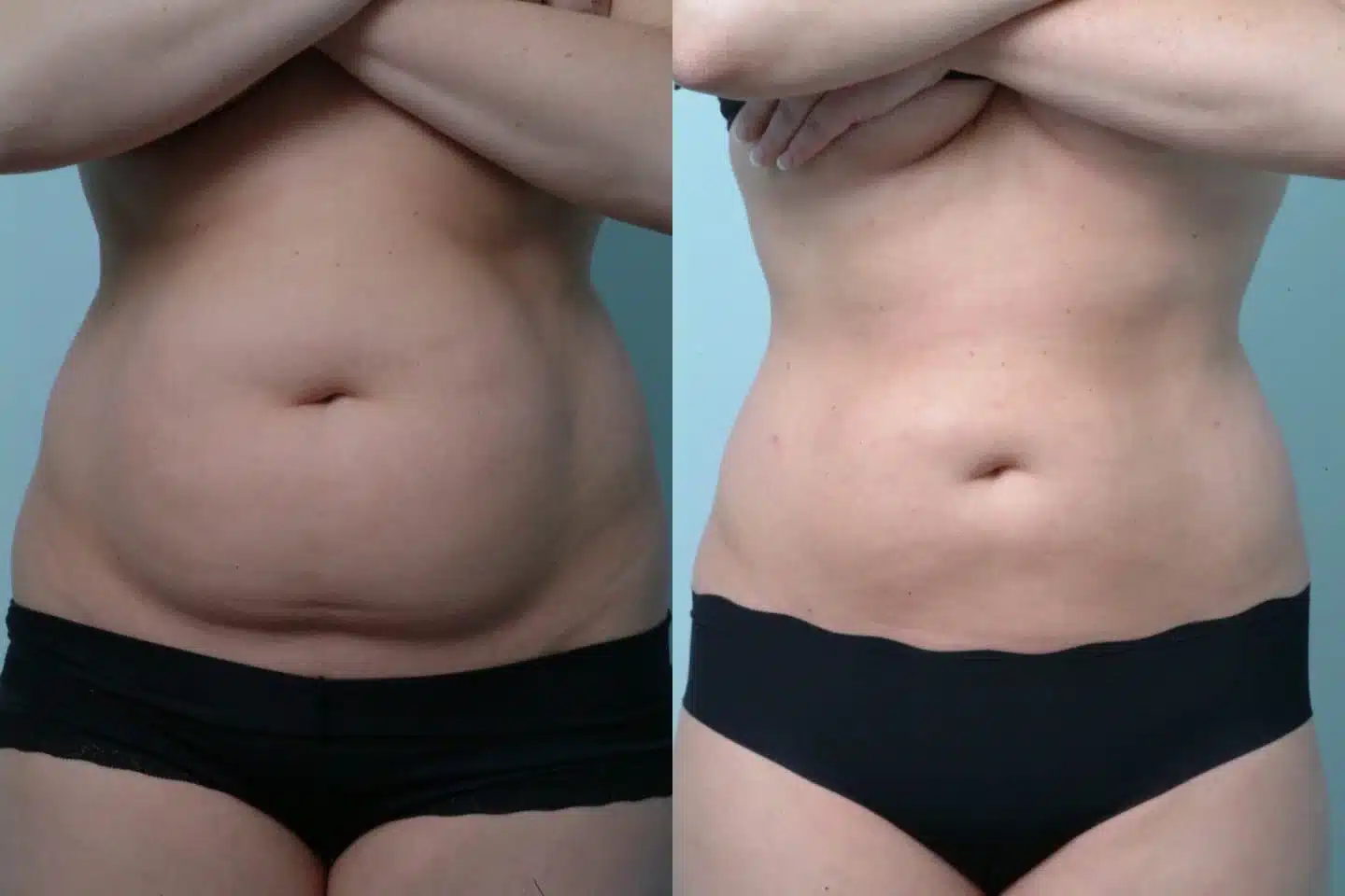 Lipo Gone Wrong3