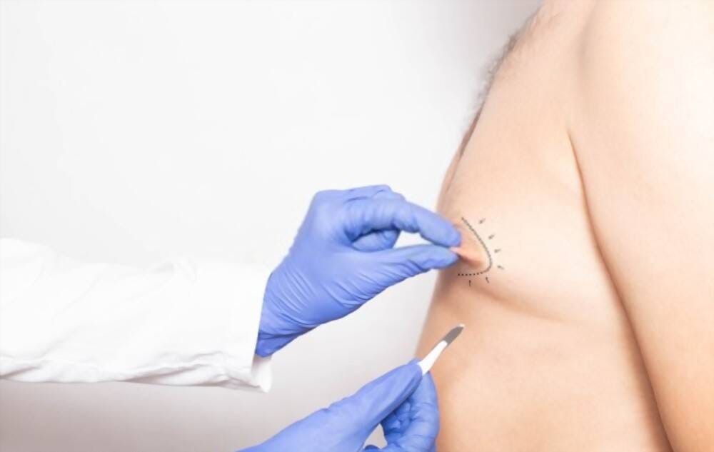 Men's Gynecomastia Surgery