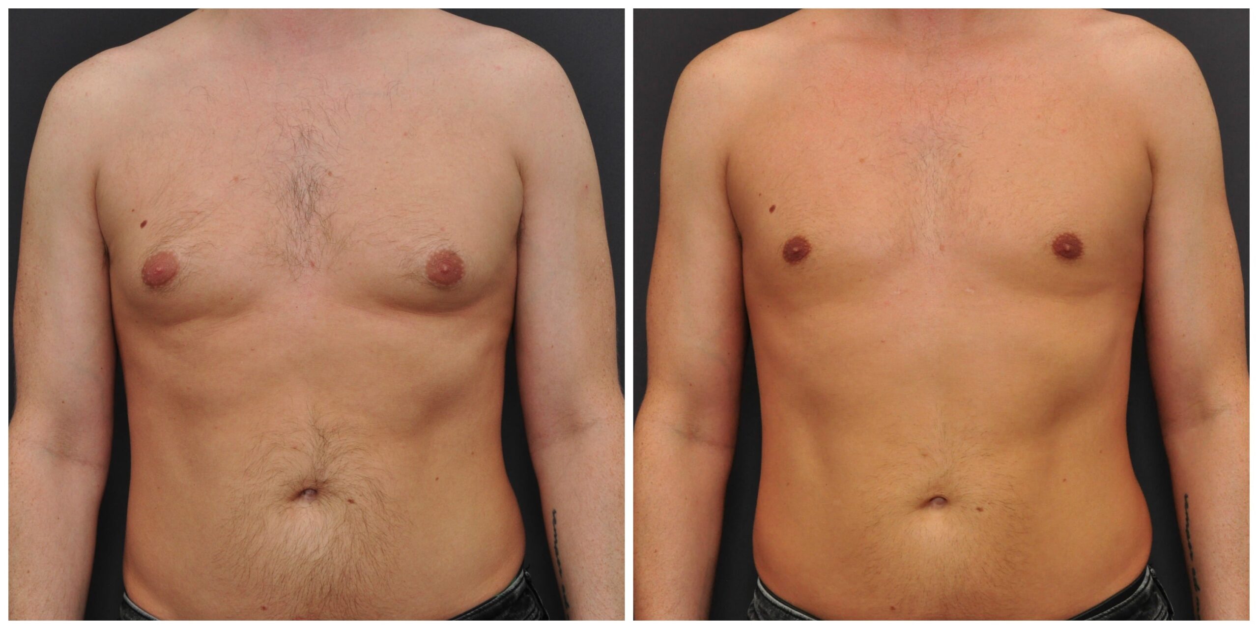 Men's gynecomastia surgery