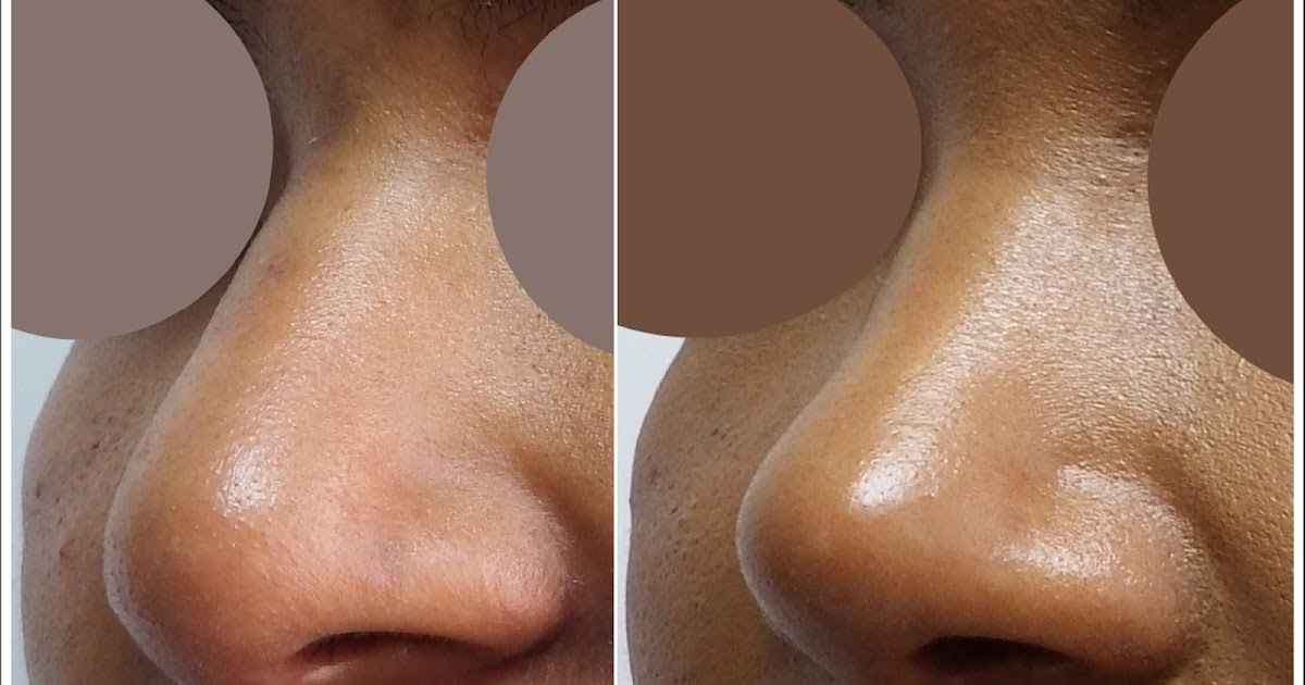 Rhinoplasty Istanbul