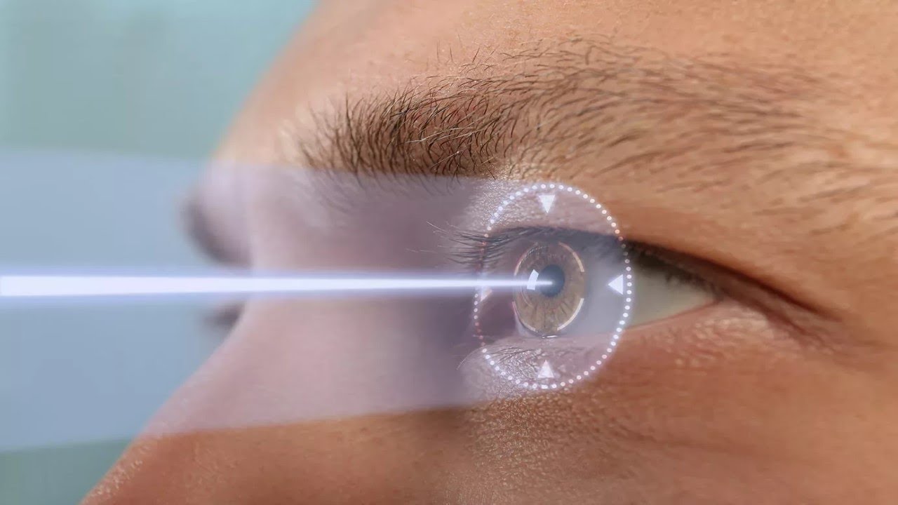 Smile laser eye surgery vs LASIK