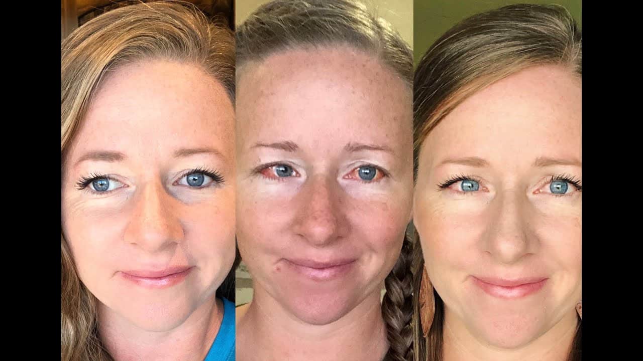 Surgery for strabismus