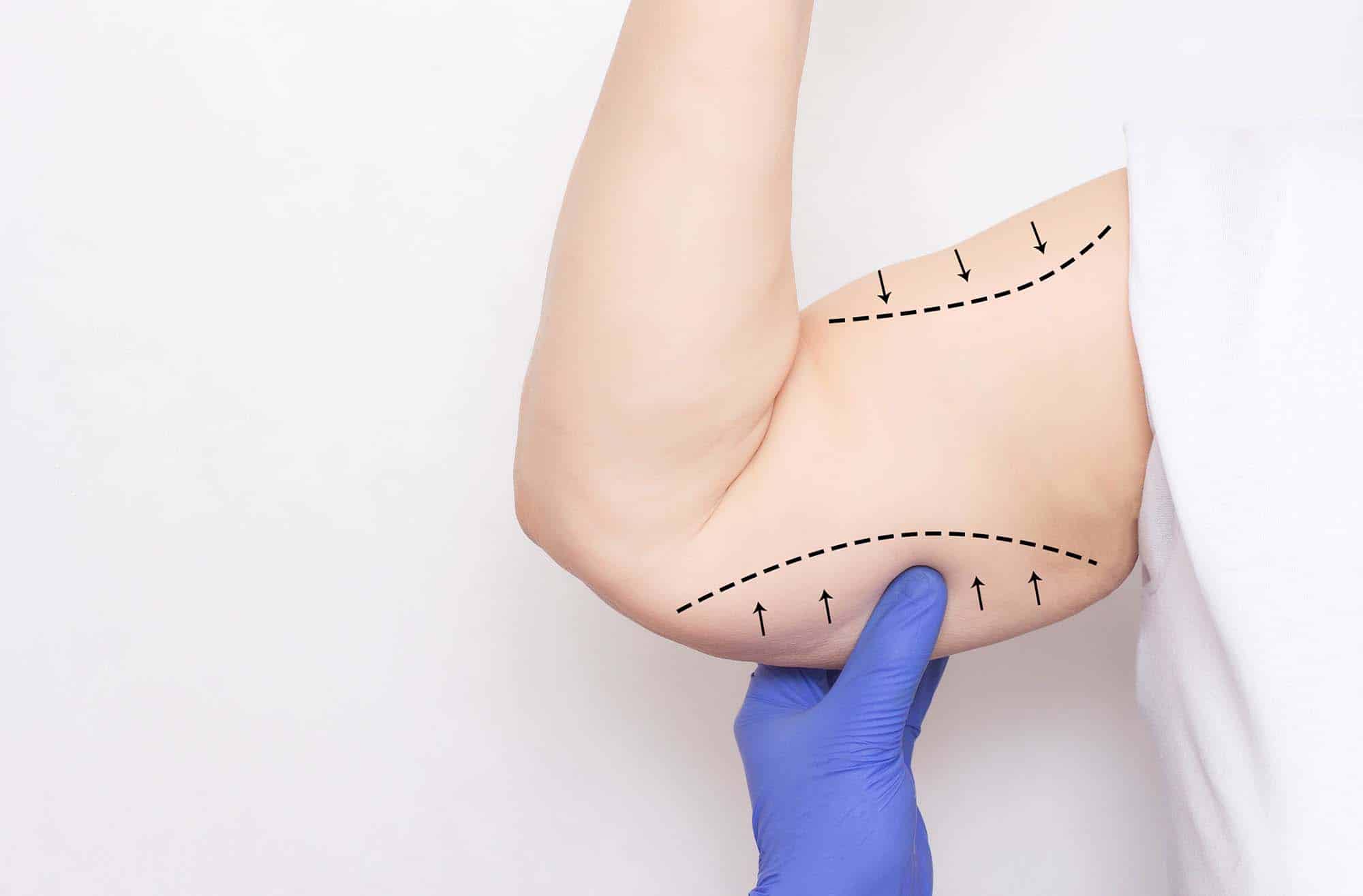 Thigh lift procedures