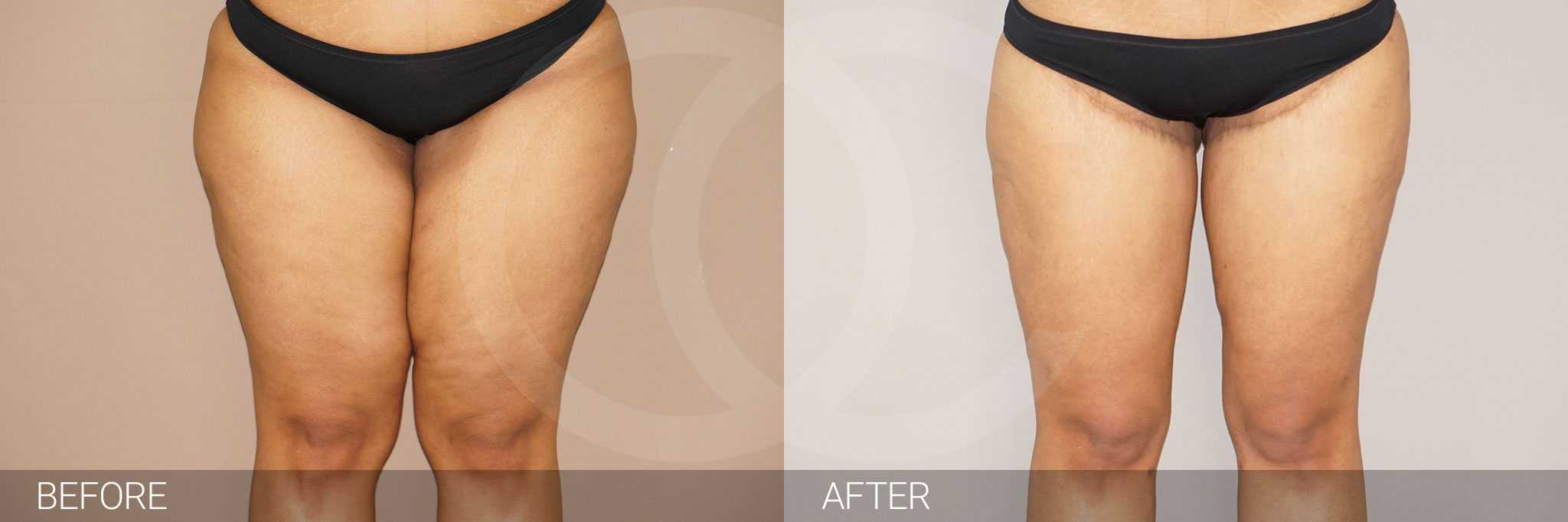 Thigh lift procedures