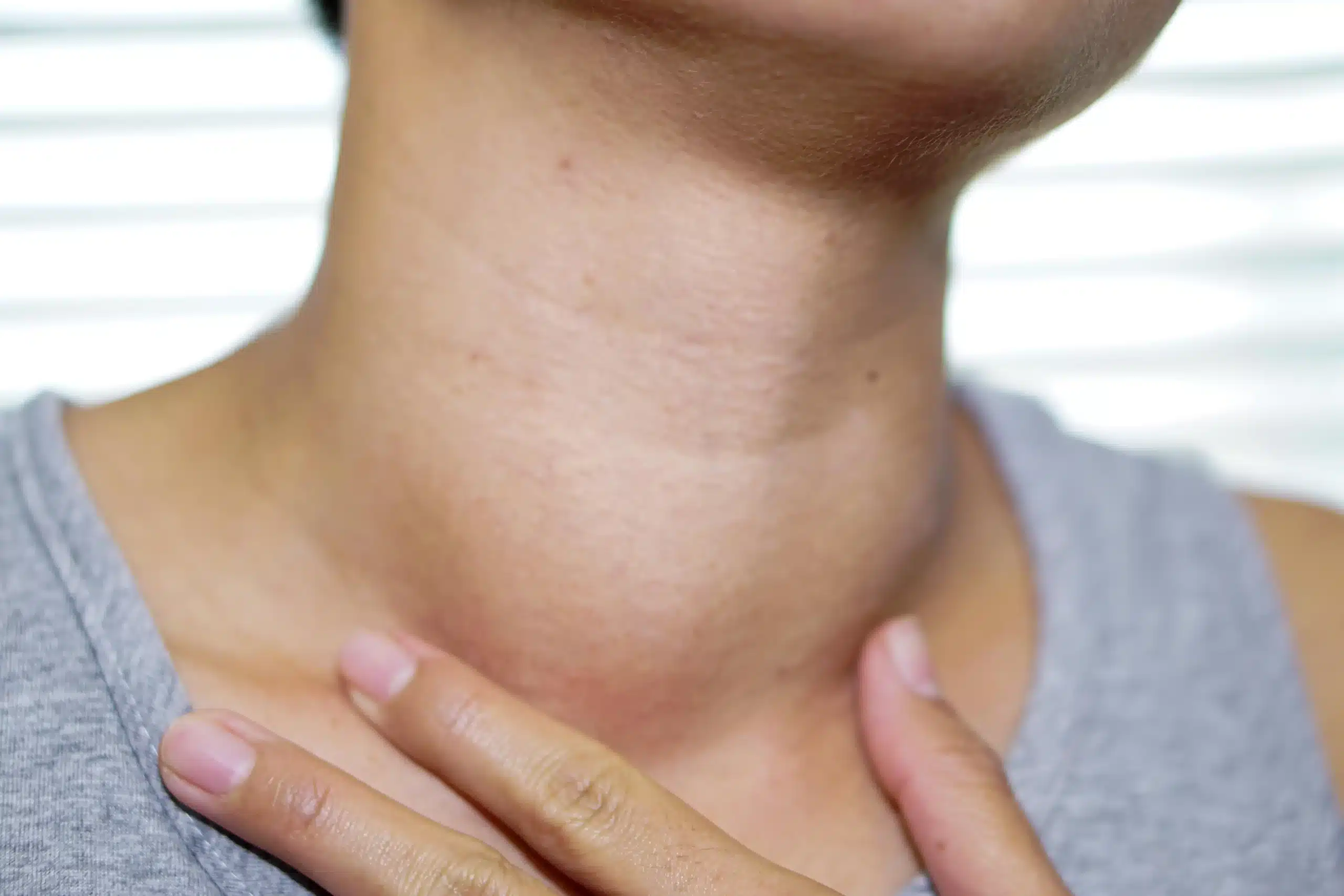 What Causes Turkey Neck?