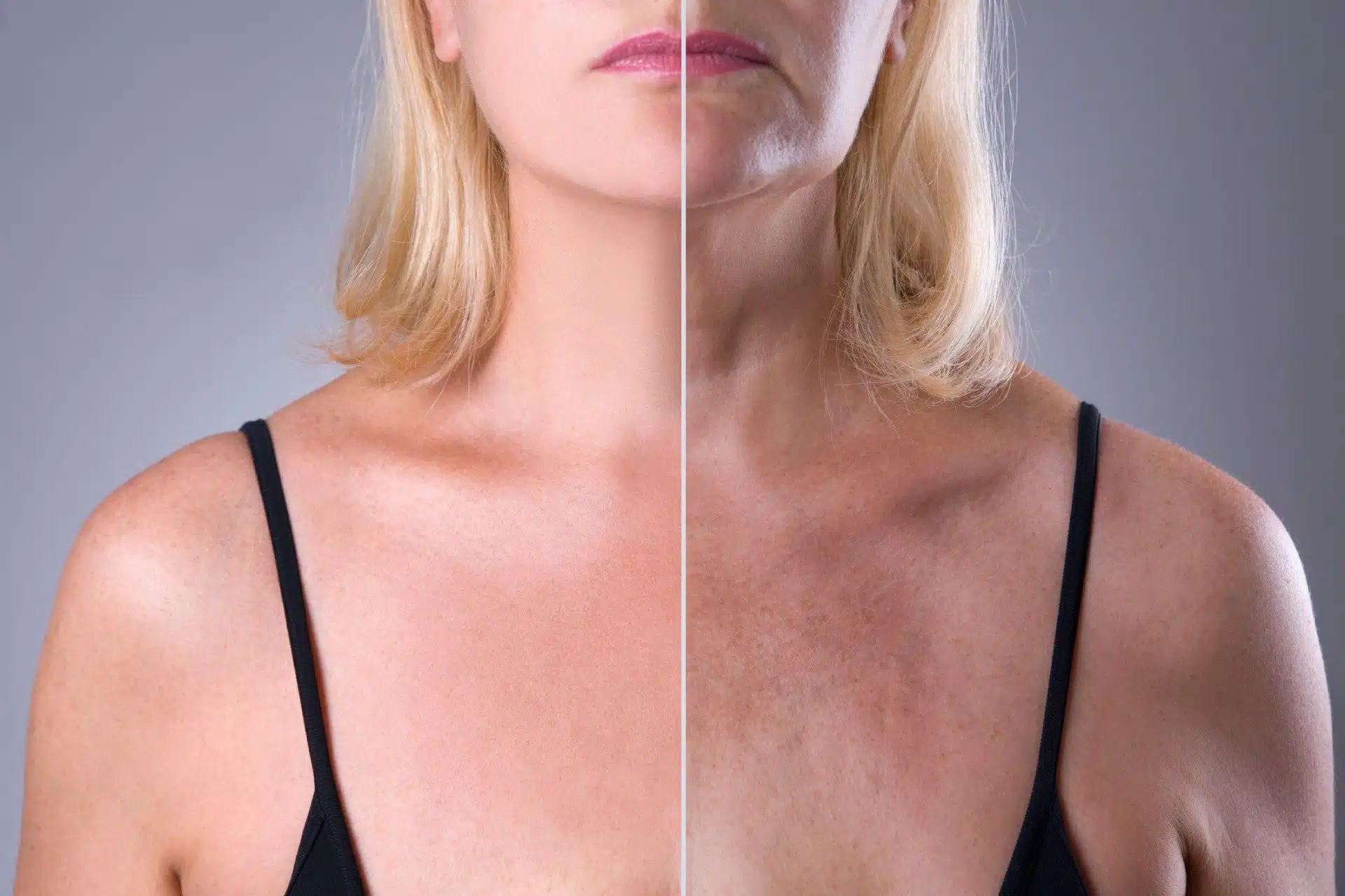 What Causes Turkey Neck?