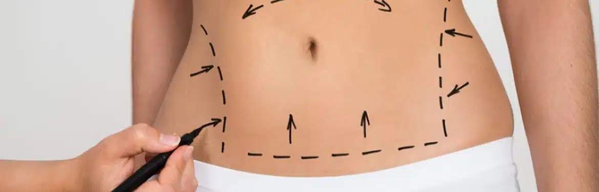 abdominoplasty turkey