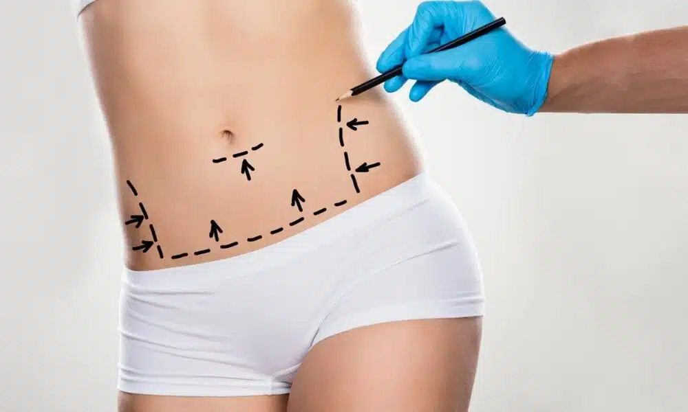 abdominoplasty turkey
