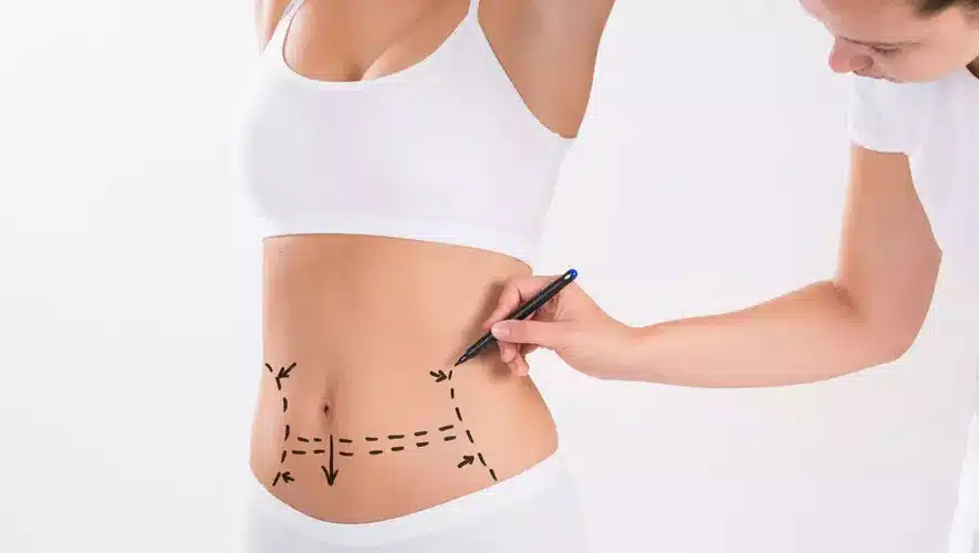 abdominoplasty turkey
