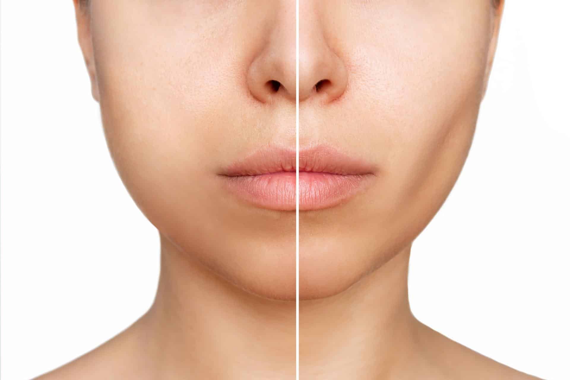 buccal fat removal regret1