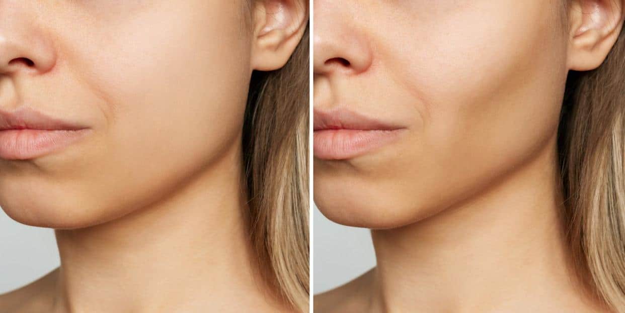 buccal fat removal regret2