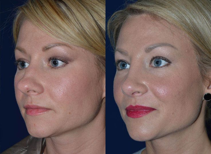 bulbous nose rhinoplasty cost