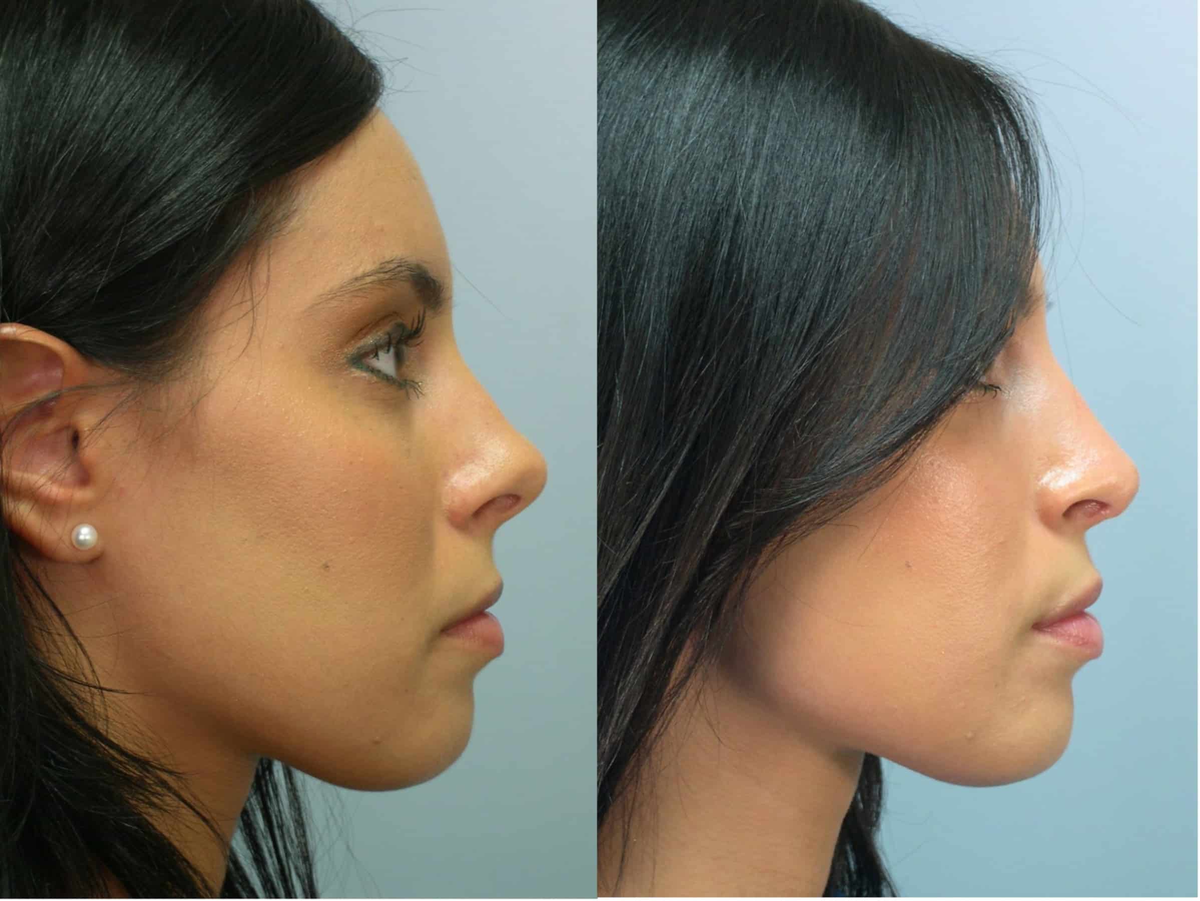 bulbous nose rhinoplasty cost
