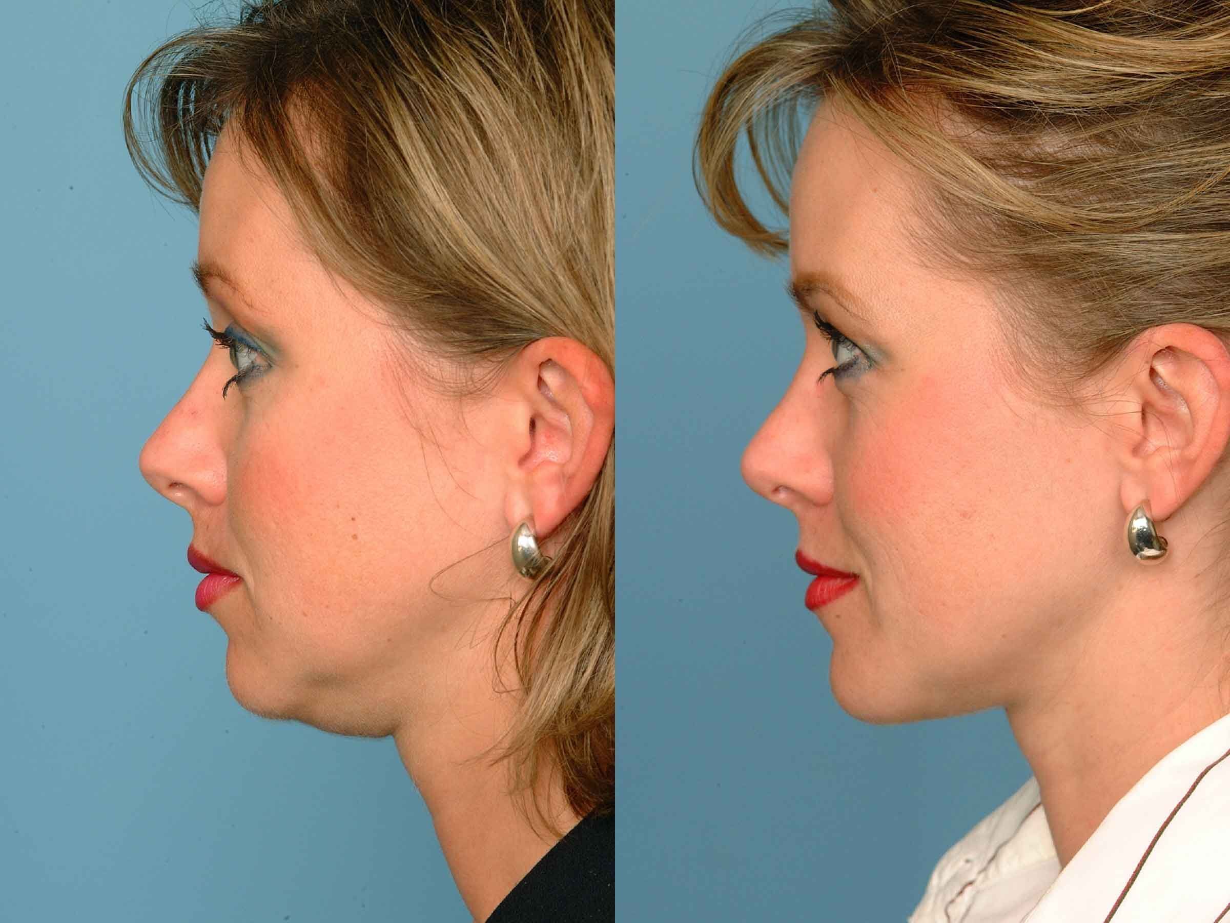 chin lipo