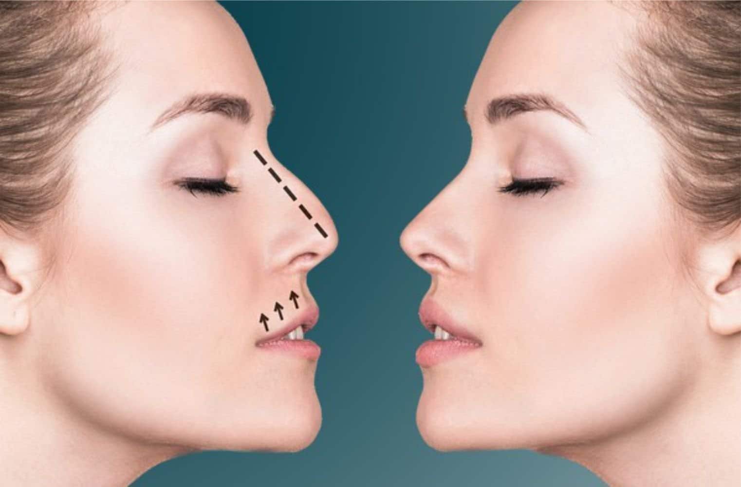 cost of nose reduction