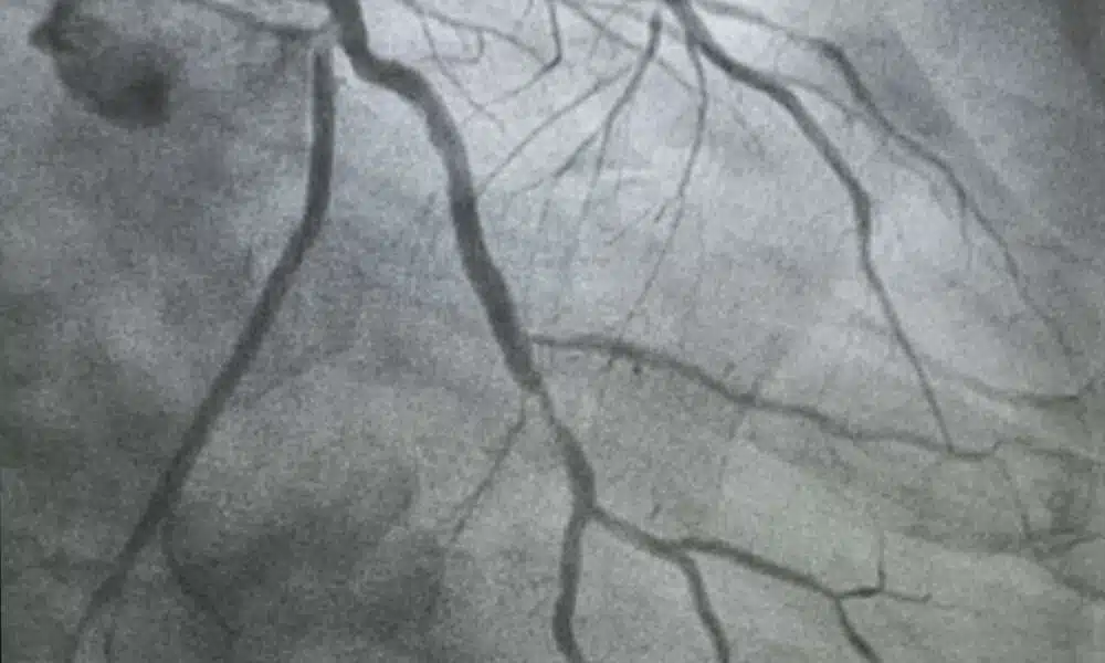 Coronary Angiography in turkey