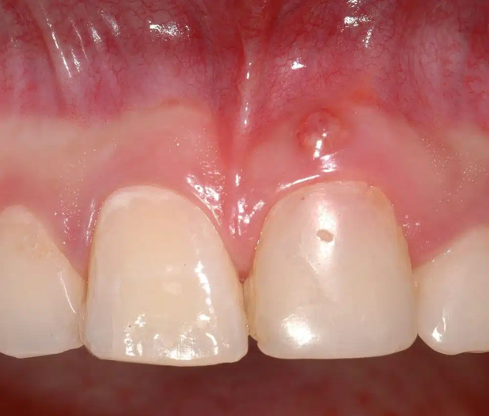 fistula in mouth