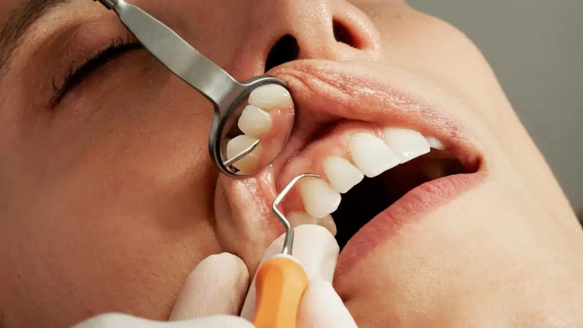 fistula in mouth