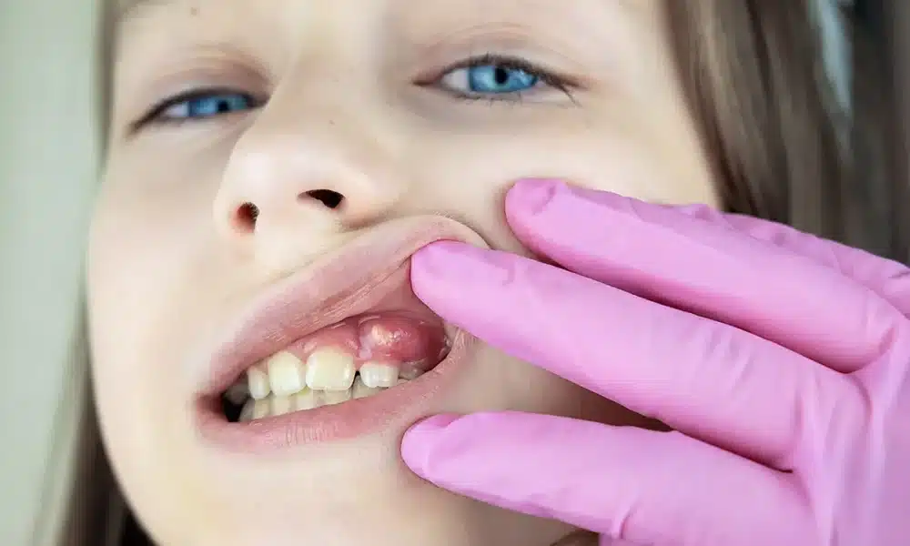 fistula in mouth