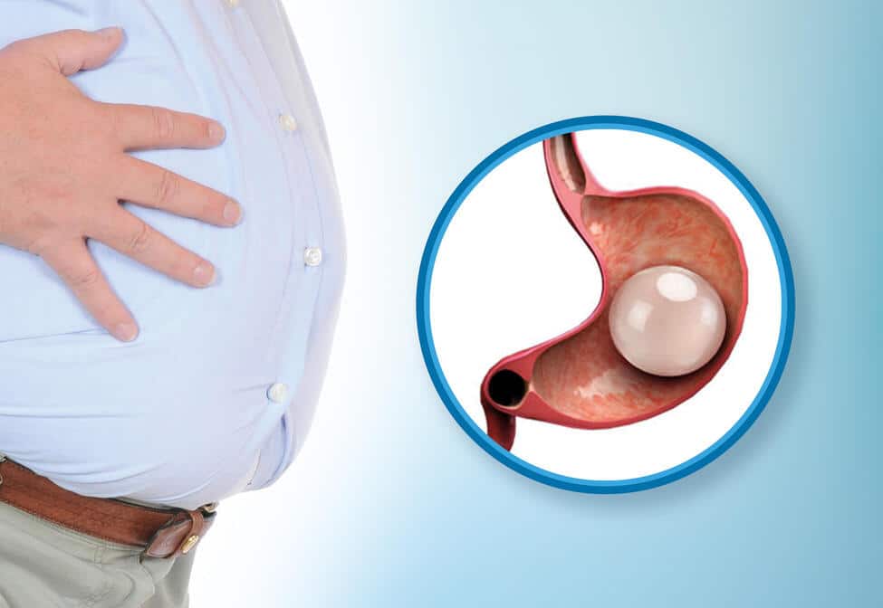 gastric balloon