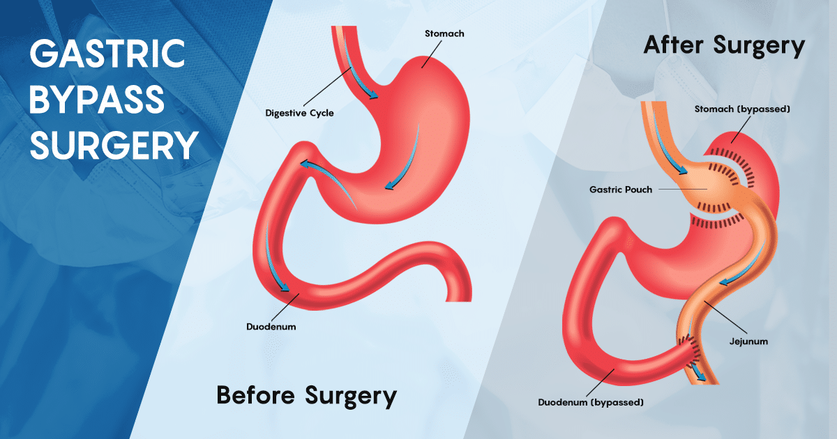 gastric bypass financial assistance