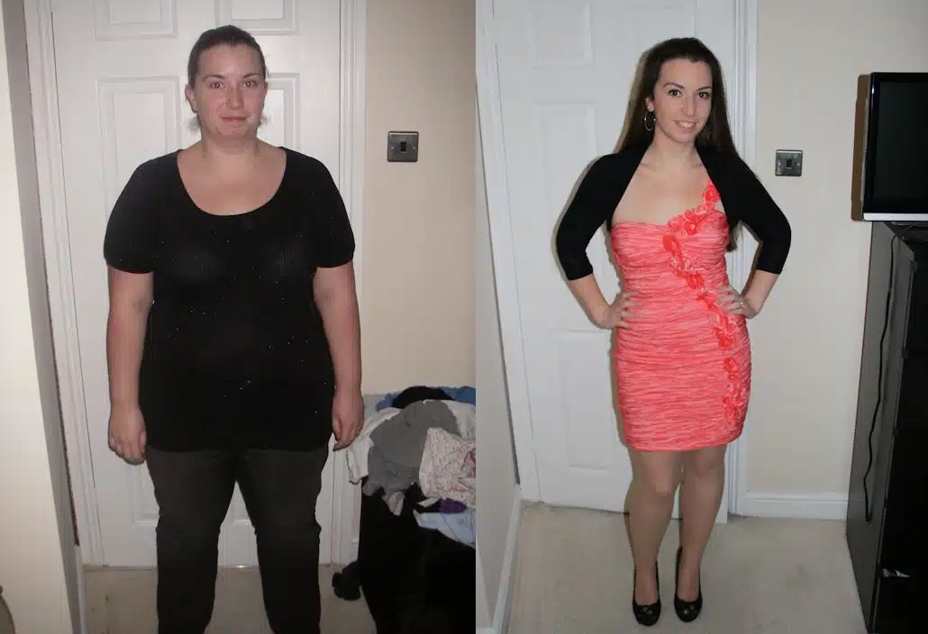 gastric sleeve before after