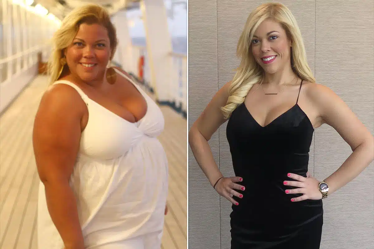 gastric sleeve before after
