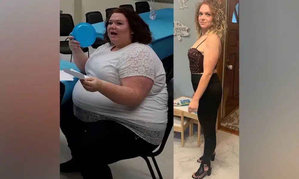 gastric sleeve before after