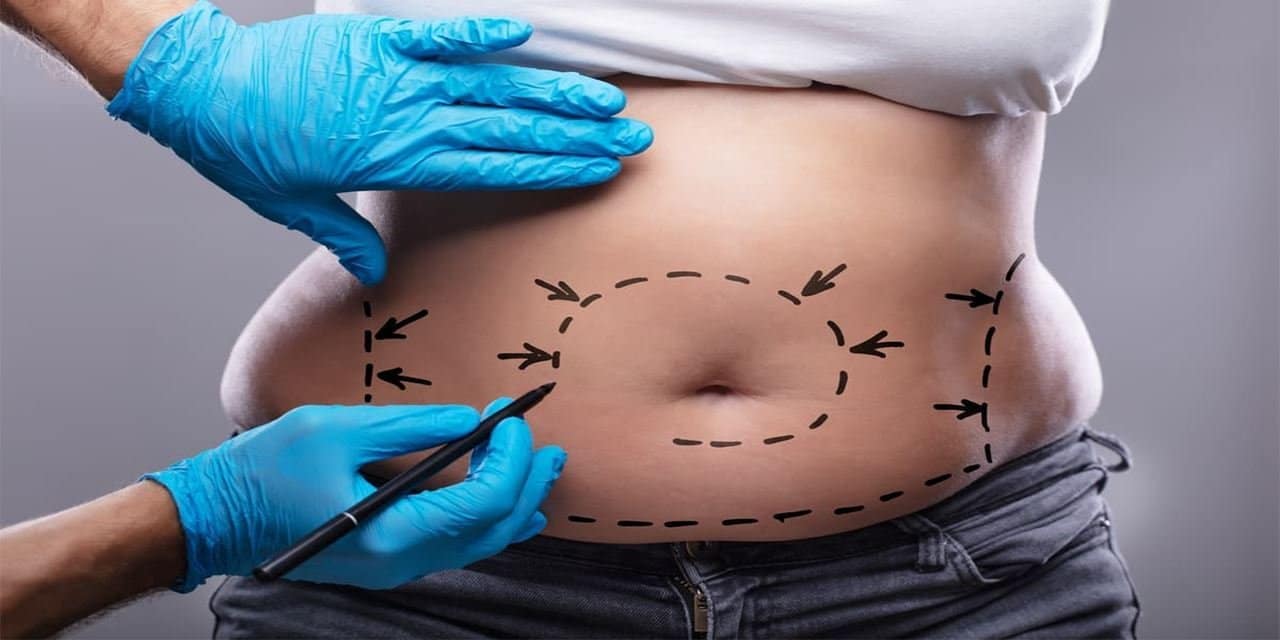 hourglass tummy tuck