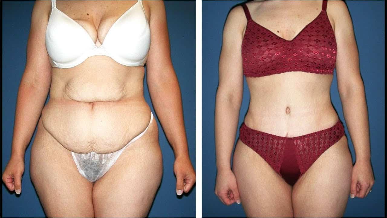 hourglass tummy tuck