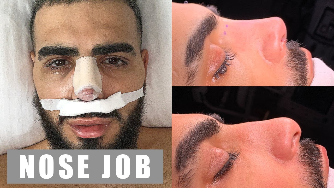 how much does a nose job cost in Turkey ?