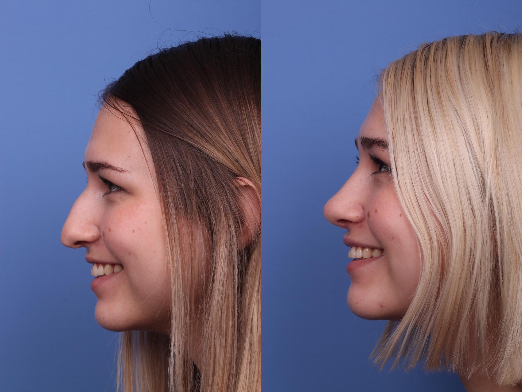 how much does a nose job cost in Turkey ?