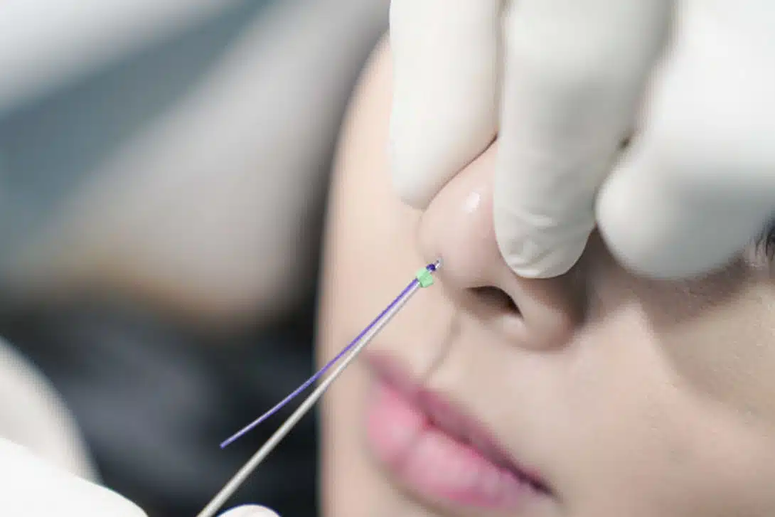 how much is a nose lift